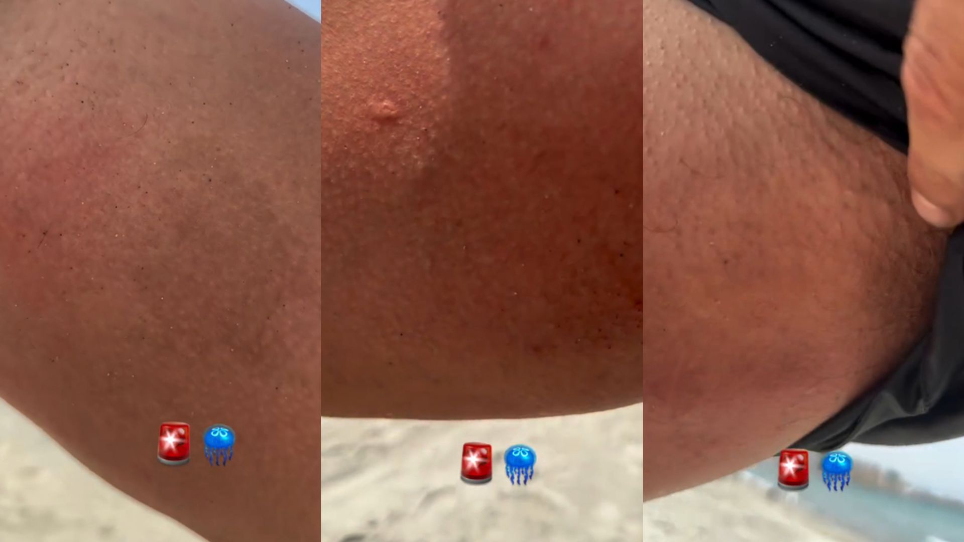 Cristian Suescun muestra sus ingles inflamadas tras recibir la picadura de una medusa en la playa