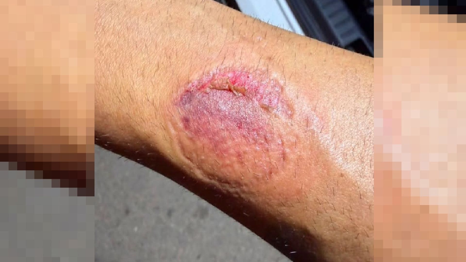 El mordisco dejó en el brazo del agente una visible marca El mordisco dejó en el brazo del agente una visible marca