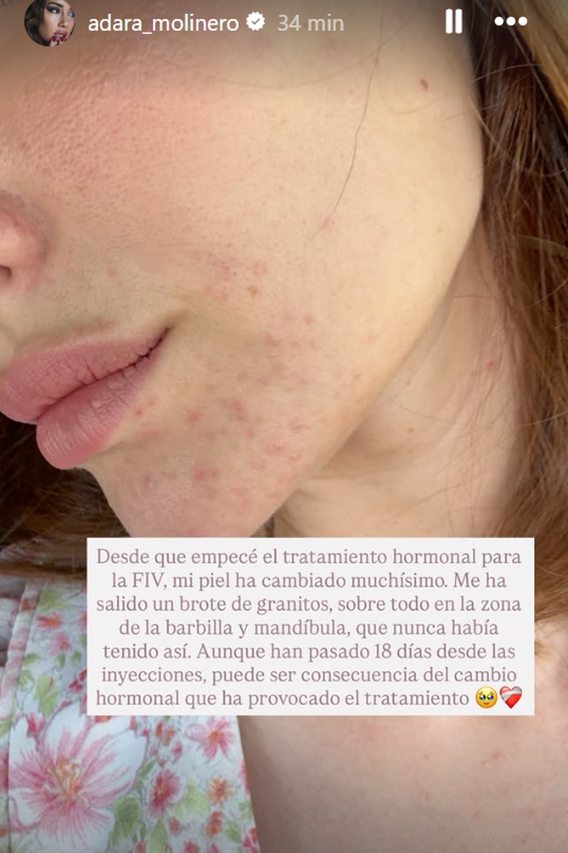 El brote en la piel de Adara Molinero