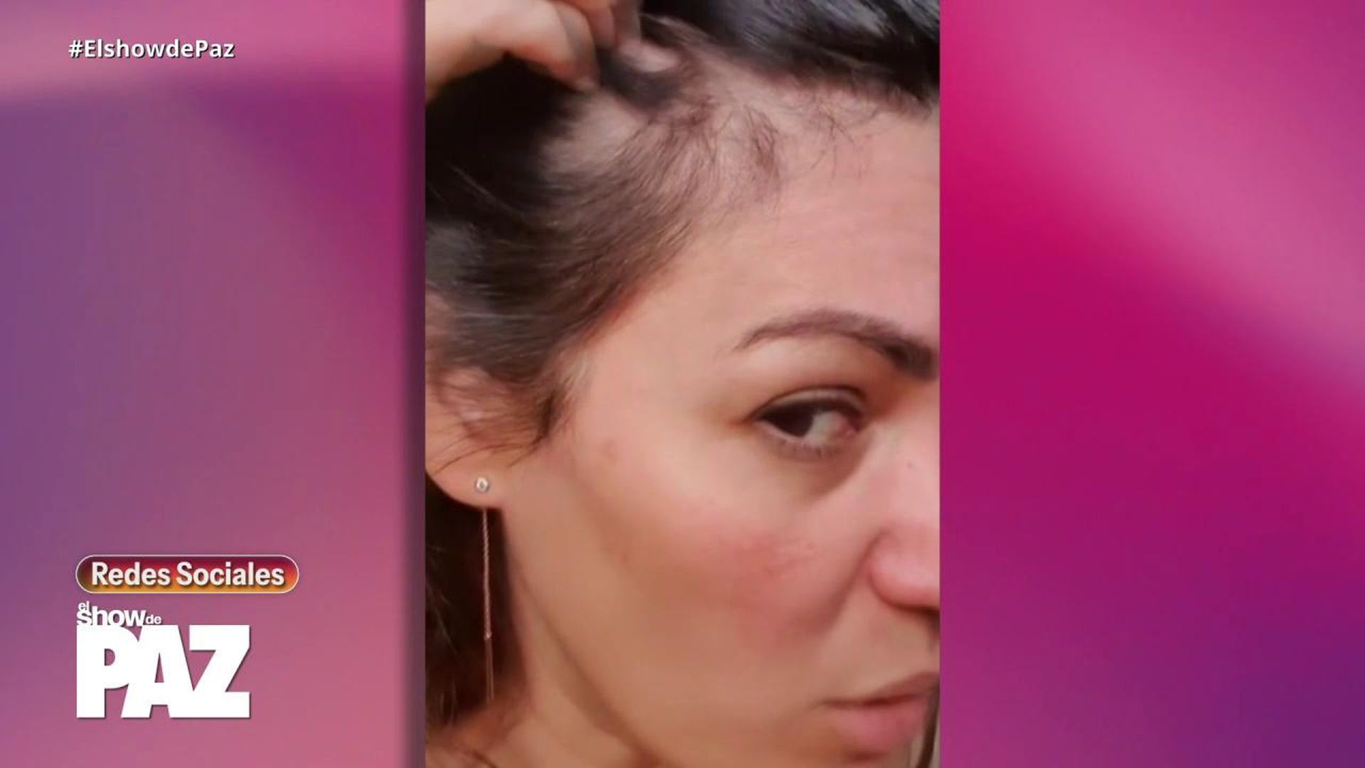 Fabiola alopecia