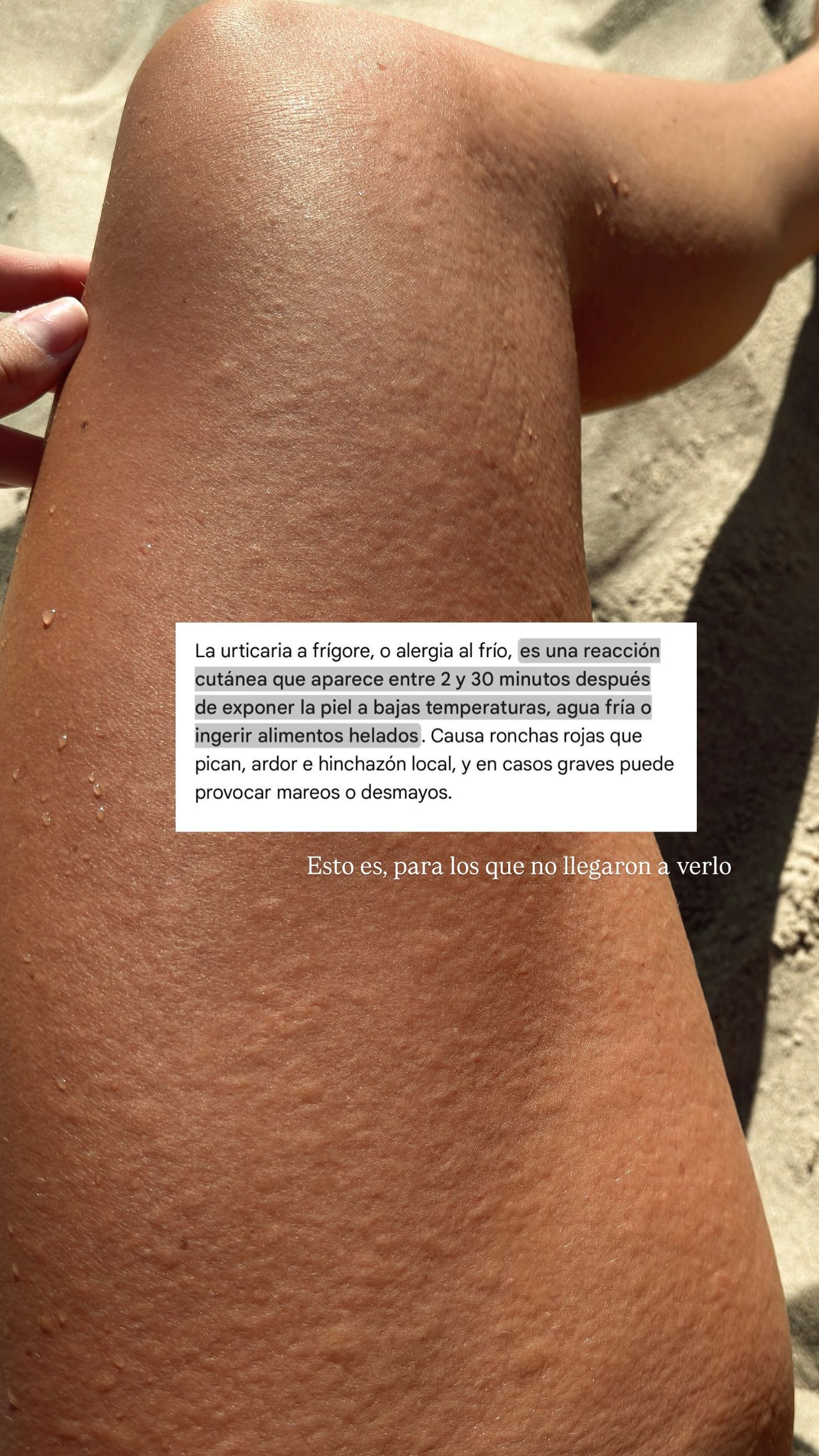 La piel de Marina cuando le da la reacción alérgica