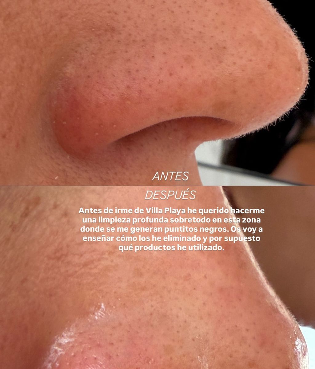 El antes y el después de los poros tras la rutina