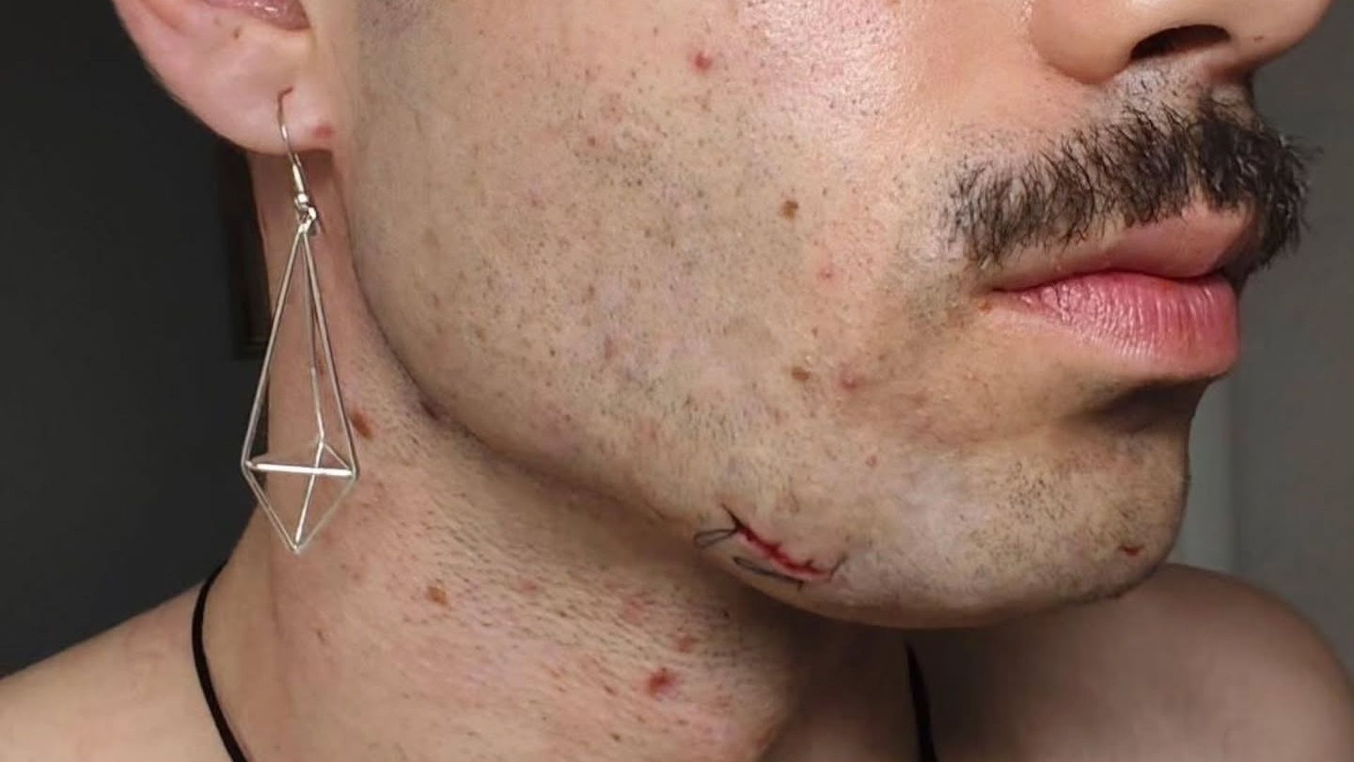 Brecha en la cara que sufrió el joven agredido Brecha en la cara que sufrió el joven agredido