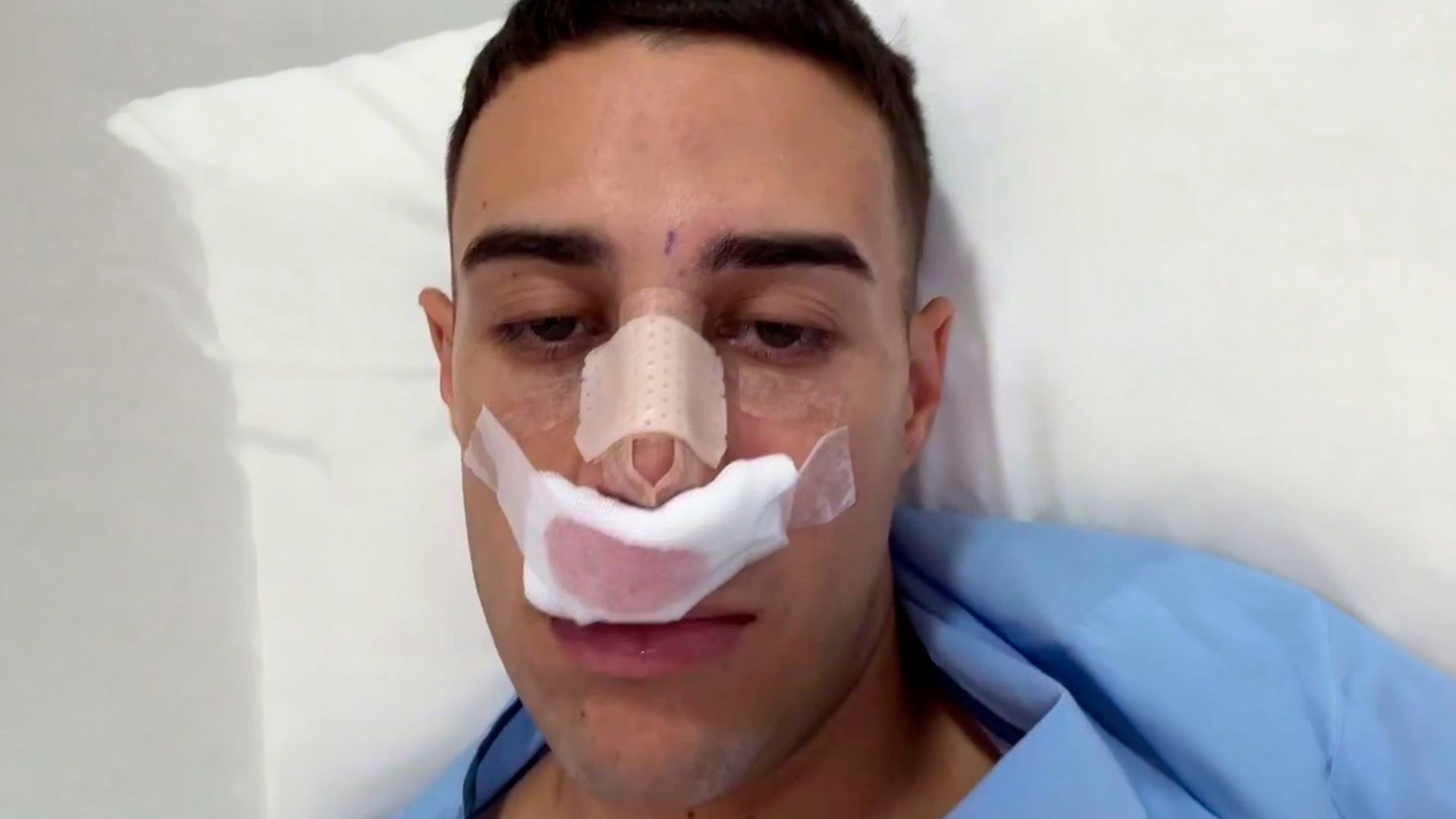 Borja Silva se somete a una rinoplastia y desvela cómo está siendo el postoperatorio Borja Silva se somete a una rinoplastia y desvela cómo está siendo el postoperatorio