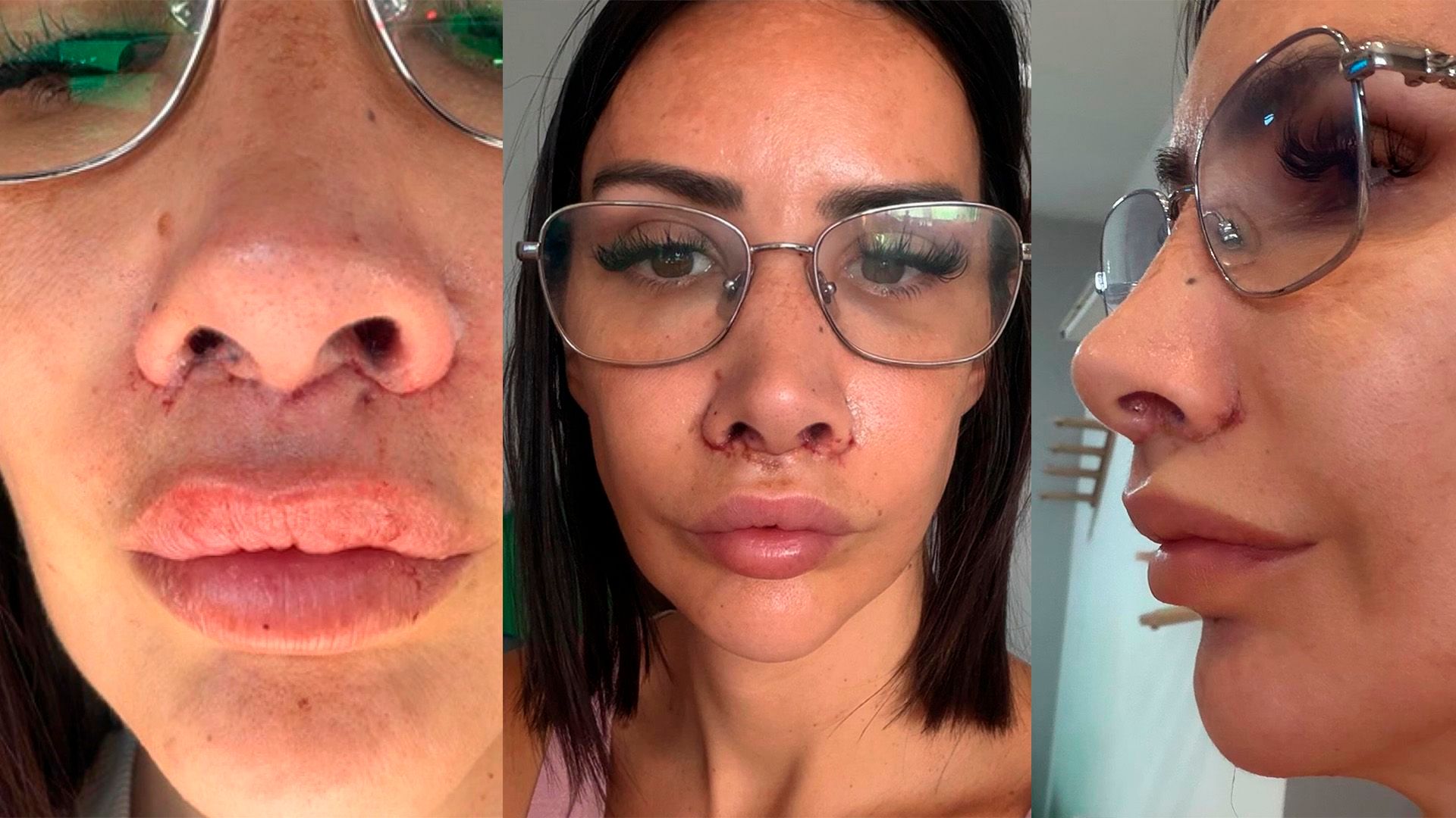 El proceso de postoperatorio del 'lip lift' de Fani Carbajo