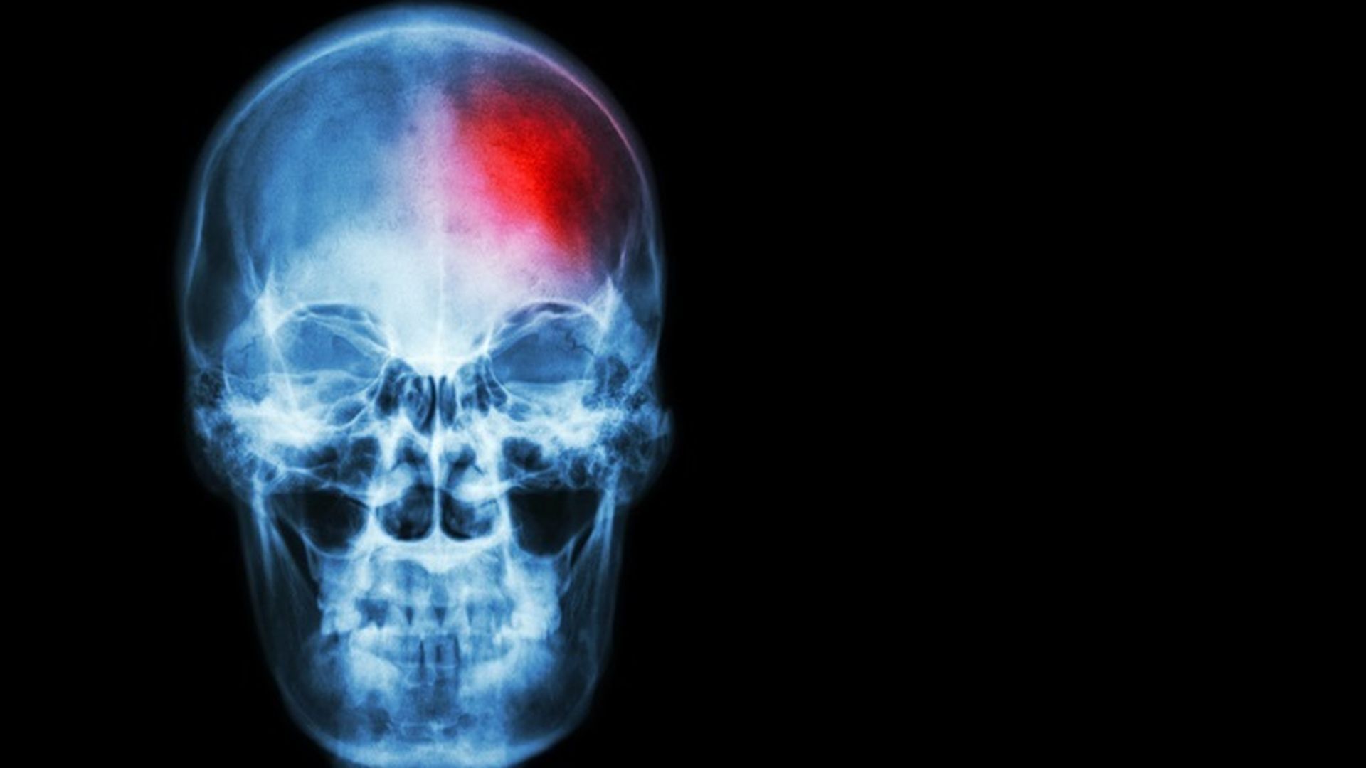 Descubren una señal de las bacterias intestinales que podría influir en el daño cerebral tras un ictus Descubren una señal de las bacterias intestinales que podría influir en el daño cerebral tras un ictus