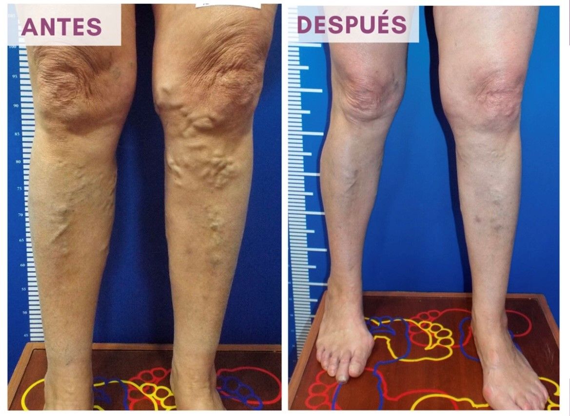 Antes y después de una tratamiento para solucionar los problemas de varices y arañas vasculares
