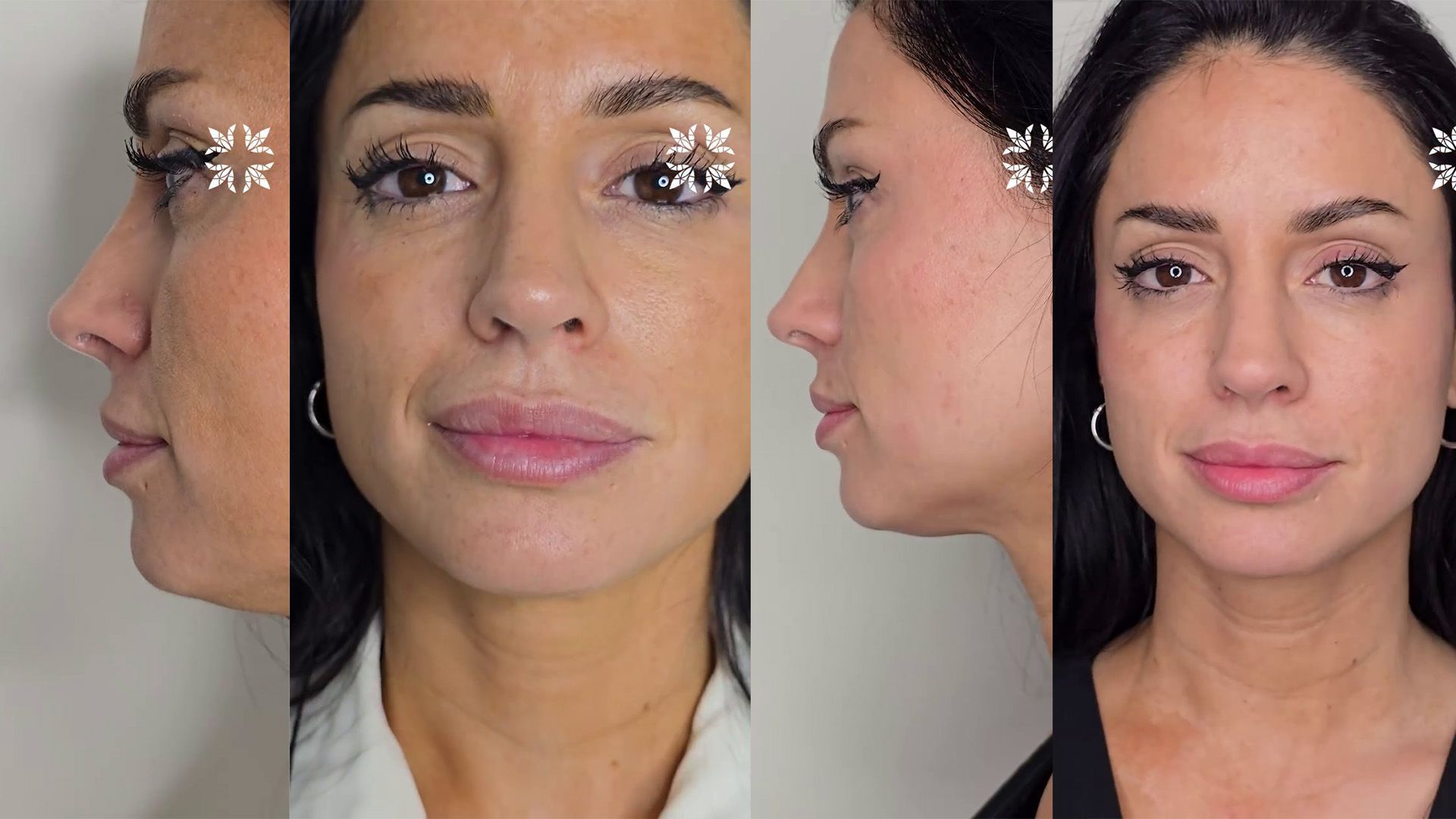 Inma Campano se retira el ácido hialurónico de los labios: su antes y después Inma Campano se retira el ácido hialurónico de los labios: su antes y después