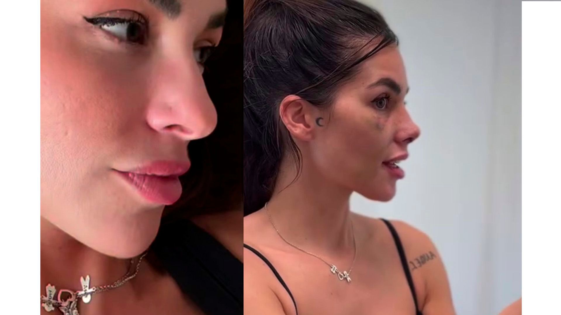 El antes y el después de la operación de Jennifer Lara