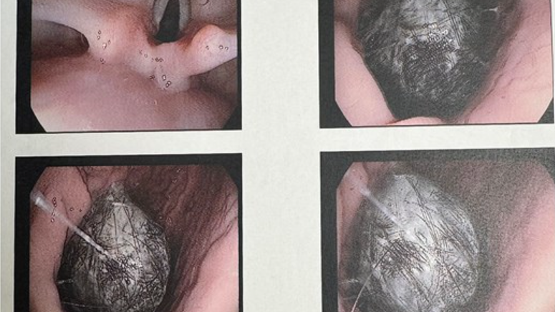 Así se sacó la bola de pelo del estómago de una joven de 27 años