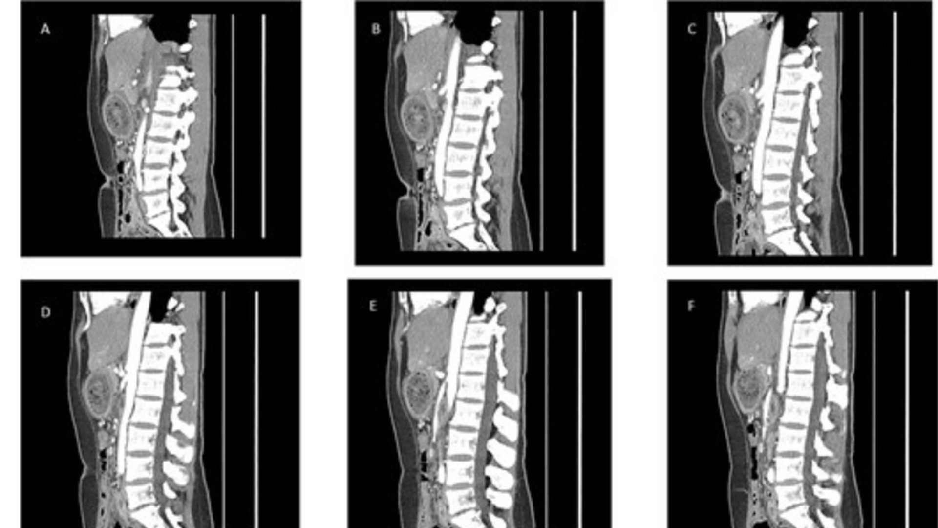 La paciente fue diagnosticada de un enorme tricobezoar gástrico.jpg