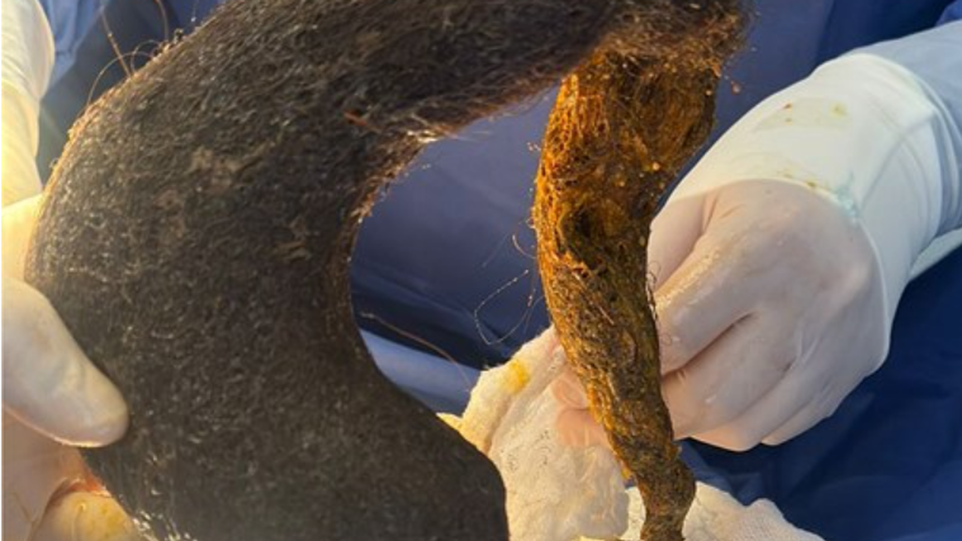 Una gigantesca bola de pelo ocupa el 90% del estómago de una mujer Una gigantesca bola de pelo ocupa el 90% del estómago de una mujer