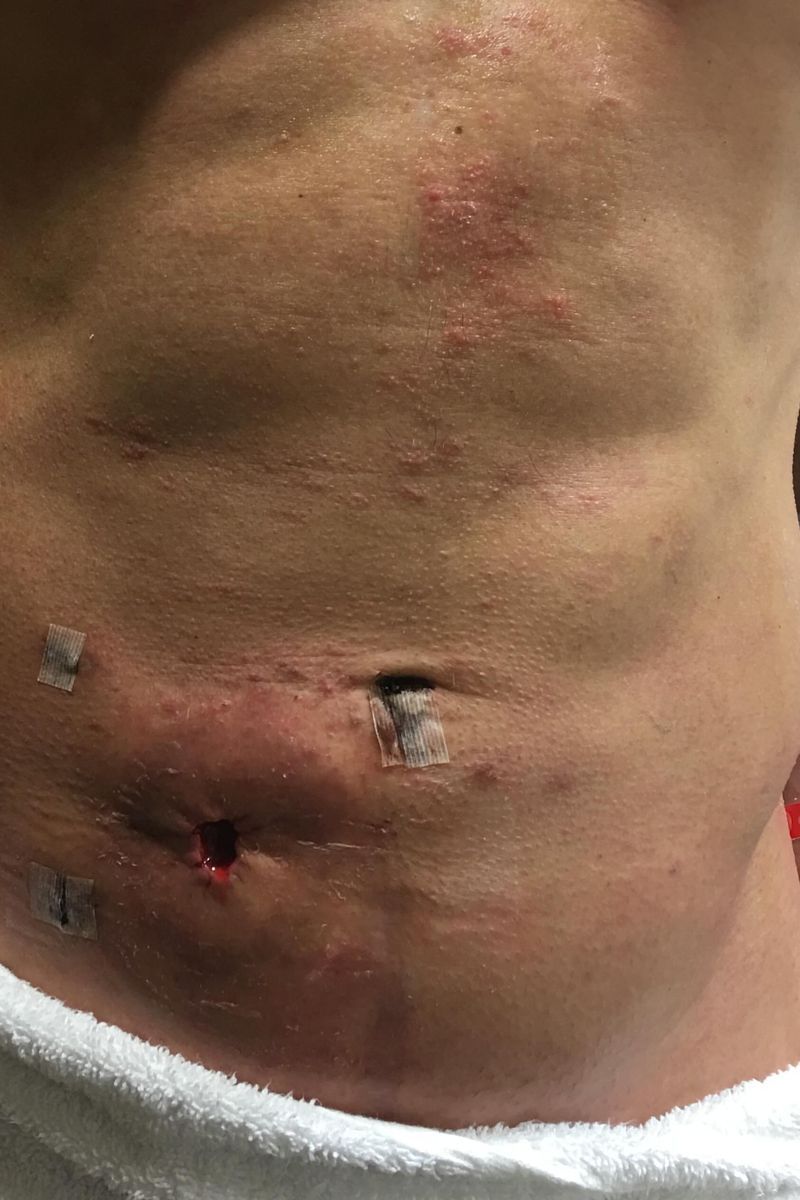 Joe Manganiello muestra las cicatrices de su cirugía de reconexión tras ser extirpado parte de su intestino grueso