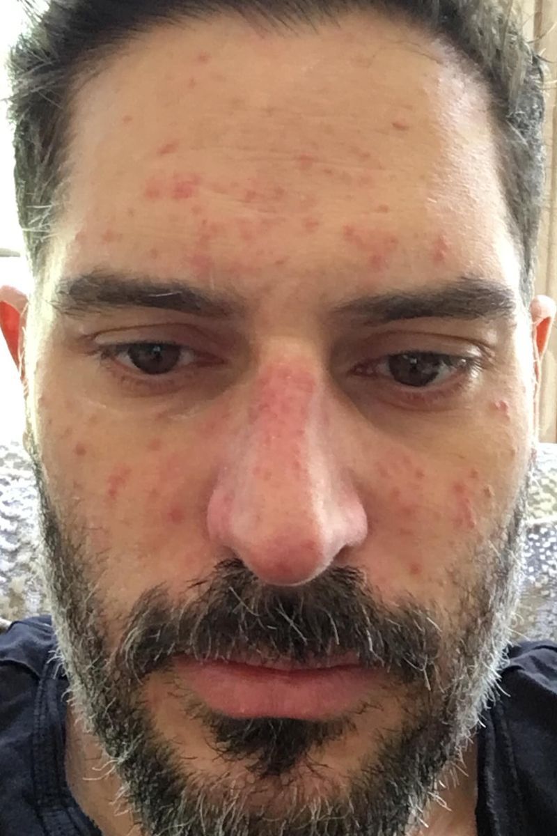 Joe Manganiello muestra las secuelas que sufrió en la piel debido a su enfermedad autoinmune