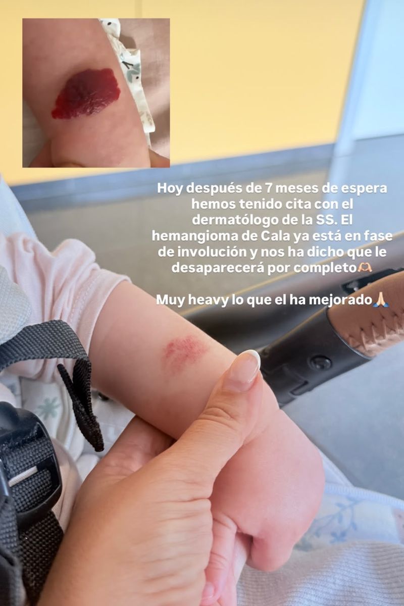 La diferencia del hemangioma de Cala