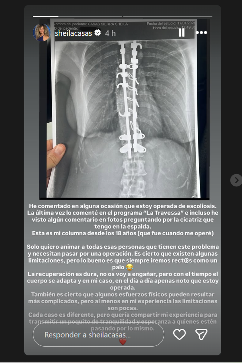 Sheila Casas enseña los problemas de su espalda