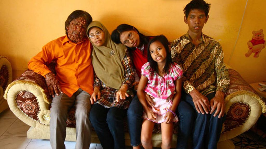 Vivir con el cuerpo cubierto de tumores